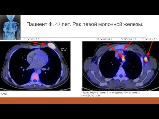 Пациент Ф. 47 лет. Рак левой молочной железы. SUVmax 7,6 Метастатическое поражение