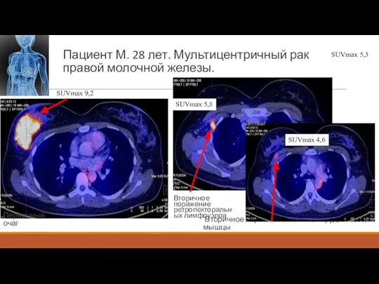 Пациент М. 28 лет. Мультицентричный рак правой молочной железы. SUVmax 9,2 Вторичное