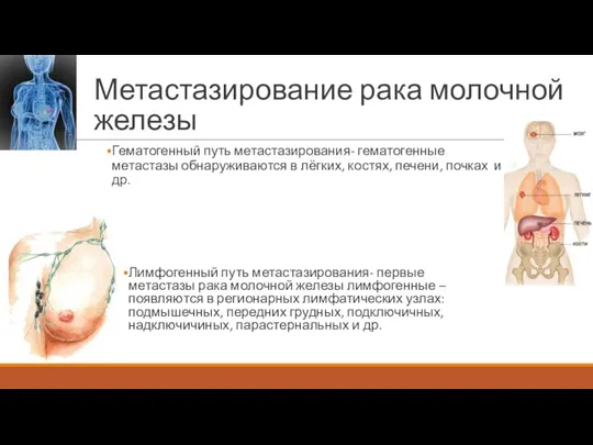 Метастазирование рака молочной железы Лимфогенный путь метастазирования- первые метастазы рака молочной железы