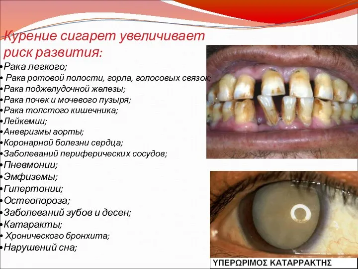 Курение сигарет увеличивает риск развития: Рака легкого; Рака ротовой полости, горла, голосовых