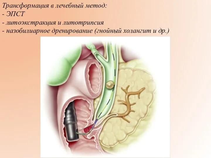 Трансформация в лечебный метод: - ЭПСТ - литоэкстракция и литотрипсия - назобилиарное