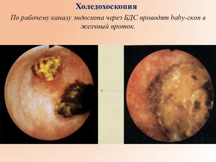 Холедохоскопия По рабочему каналу эндоскопа через БДС проводят baby-скоп в желчный проток.