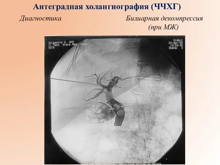 Антеградная холангиография (ЧЧХГ) Диагностика Билиарная декомпрессия (при МЖ)