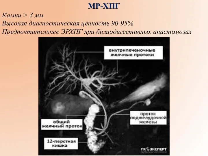 МР-ХПГ Камни > 3 мм Высокая диагностическая ценность 90-95% Предпочтительнее ЭРХПГ при билиодигестивных анастомозах