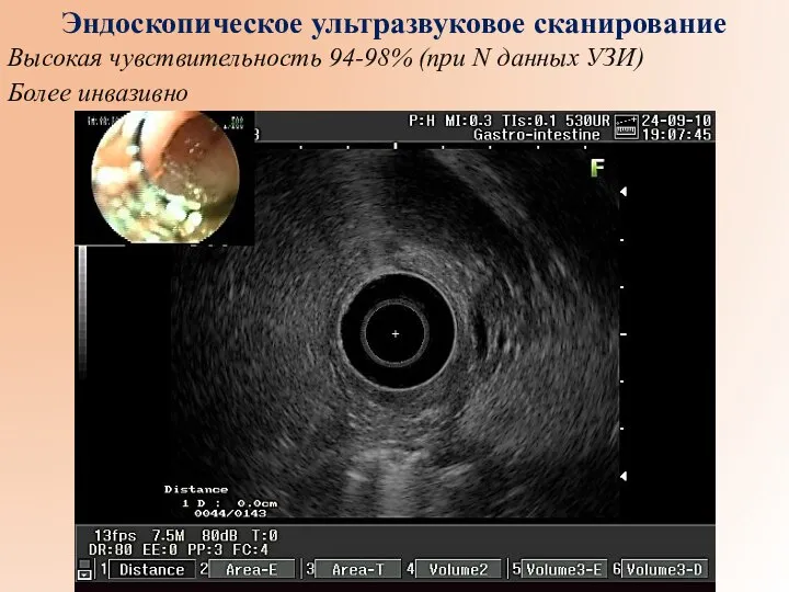 Эндоскопическое ультразвуковое сканирование Высокая чувствительность 94-98% (при N данных УЗИ) Более инвазивно