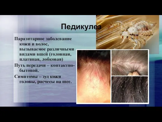 Педикулез Паразитарное заболевание кожи и волос, вызываемое различными видами вшей (головная, платяная,