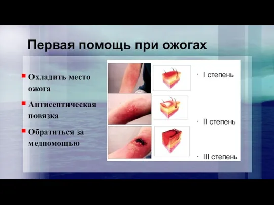 Первая помощь при ожогах Охладить место ожога Антисептическая повязка Обратиться за медпомощью