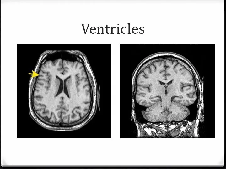 Ventricles