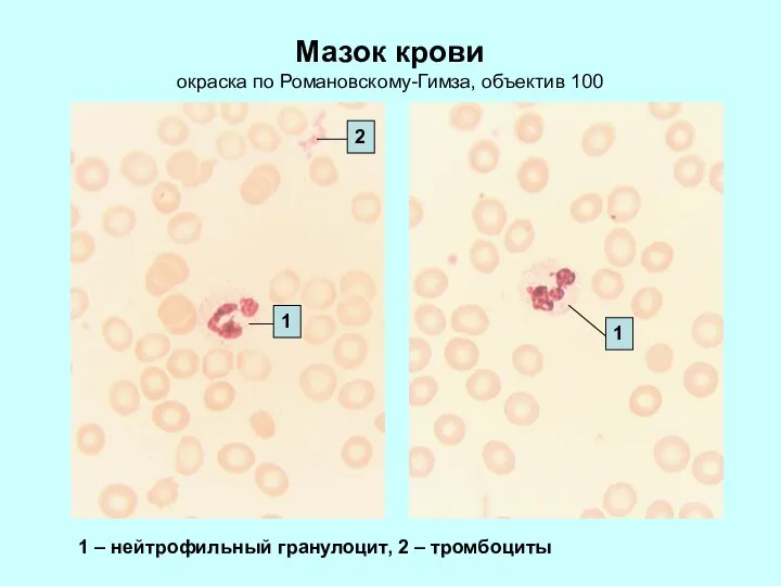 Мазок крови окраска по Романовскому-Гимза, объектив 100 1 – нейтрофильный гранулоцит, 2