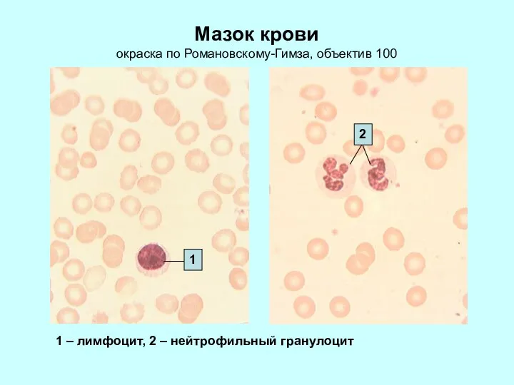 Мазок крови окраска по Романовскому-Гимза, объектив 100 1 – лимфоцит, 2 – нейтрофильный гранулоцит 1 2
