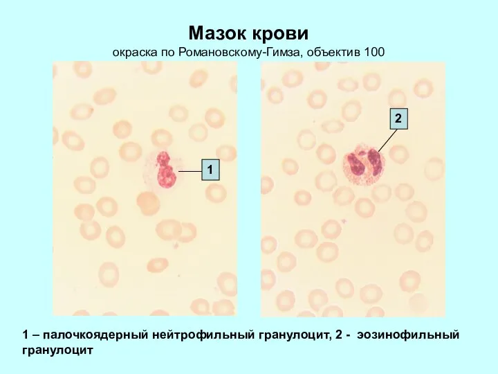 Мазок крови окраска по Романовскому-Гимза, объектив 100 1 – палочкоядерный нейтрофильный гранулоцит,