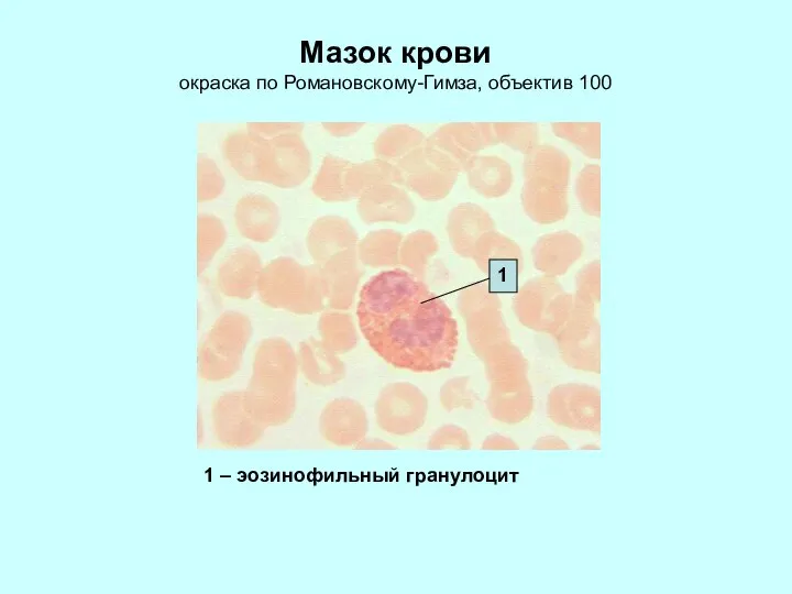 Мазок крови окраска по Романовскому-Гимза, объектив 100 1 1 – эозинофильный гранулоцит