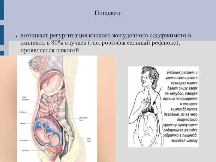 Пищевод: возникает регургитация кислого желудочного содержимого в пищевод в 80% случаев (гастроэзофагеальный рефлюкс), проявляется изжогой