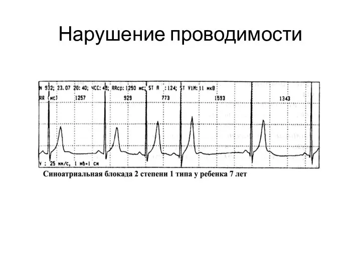 Нарушение проводимости