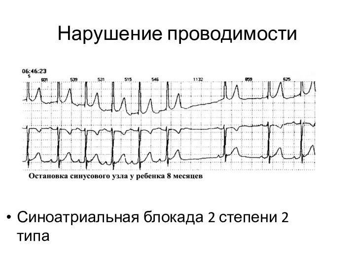 Нарушение проводимости Синоатриальная блокада 2 степени 2 типа