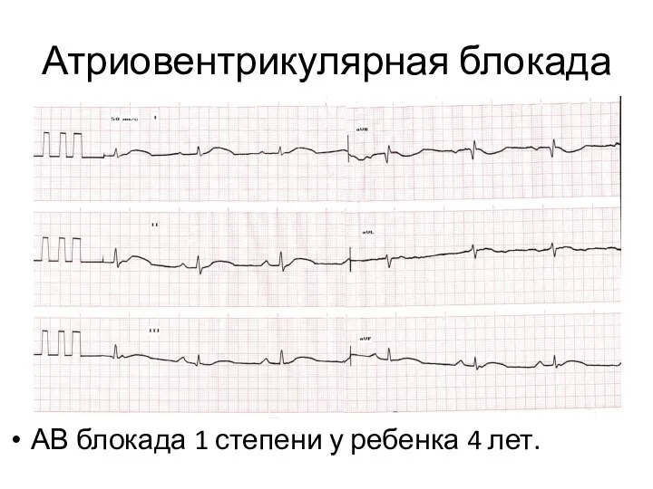 Атриовентрикулярная блокада АВ блокада 1 степени у ребенка 4 лет.