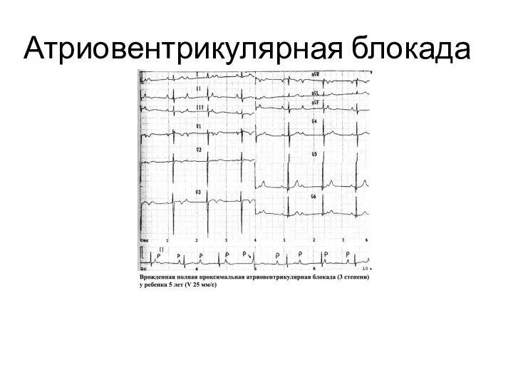 Атриовентрикулярная блокада