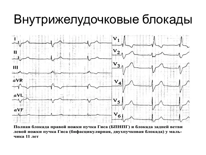 Внутрижелудочковые блокады