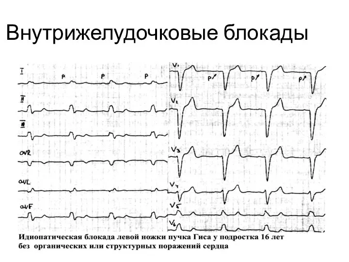 Внутрижелудочковые блокады