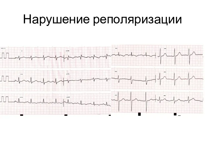 Нарушение реполяризации