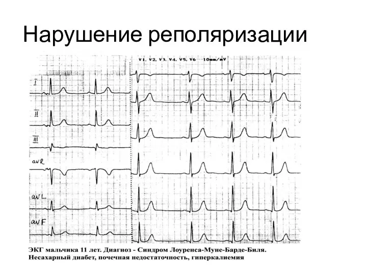 Нарушение реполяризации