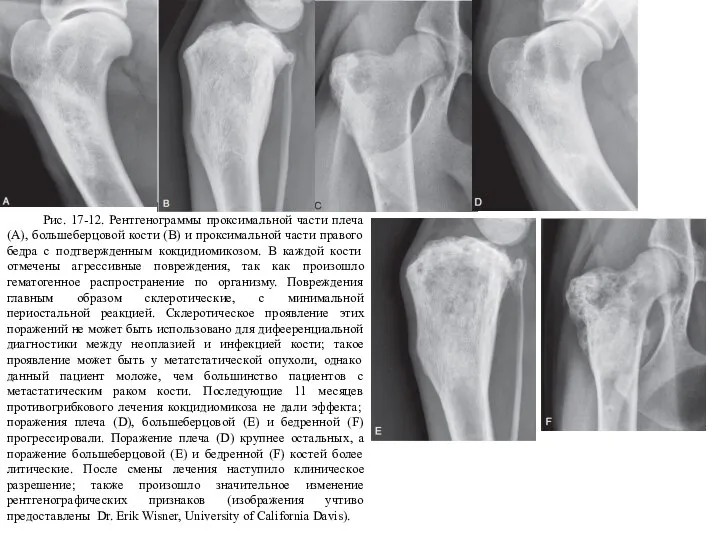 Рис. 17-12. Рентгенограммы проксимальной части плеча (А), большеберцовой кости (В) и проксимальной