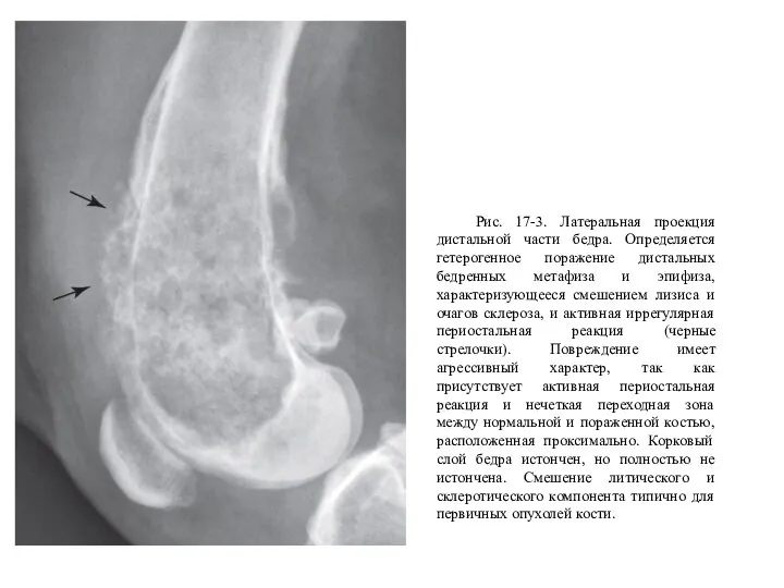 Рис. 17-3. Латеральная проекция дистальной части бедра. Определяется гетерогенное поражение дистальных бедренных