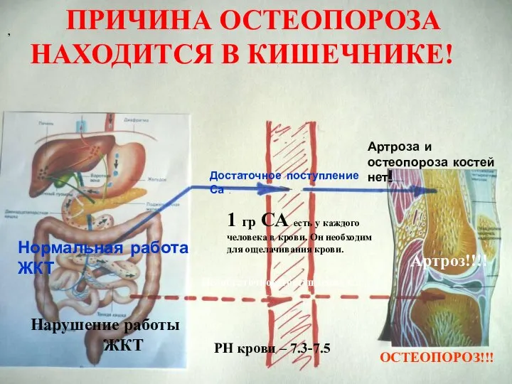 ПРИЧИНА ОСТЕОПОРОЗА НАХОДИТСЯ В КИШЕЧНИКЕ! РН крови – 7.3-7.5 1 гр СА