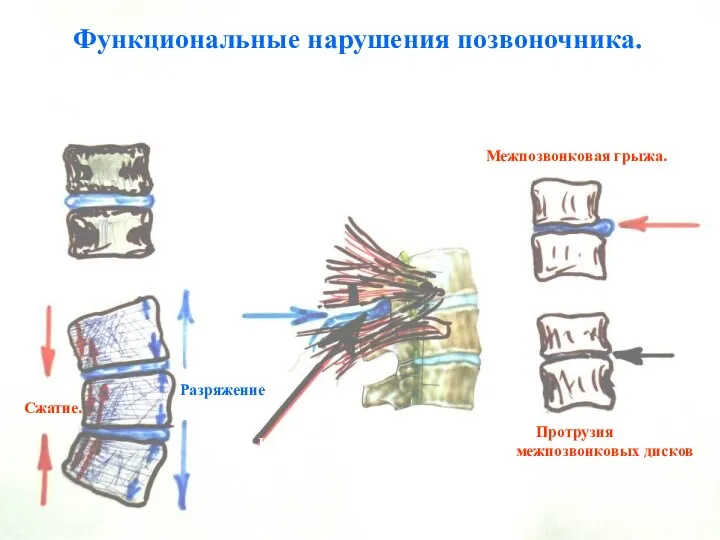 Функциональные нарушения позвоночника. Межпозвонковый диск. - норма. Сжатие. Разряжение. Выход нерва Межпозвонковая