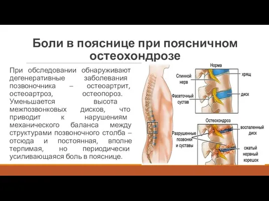 Боли в пояснице при поясничном остеохондрозе При обследовании обнаруживают дегенеративные заболевания позвоночника