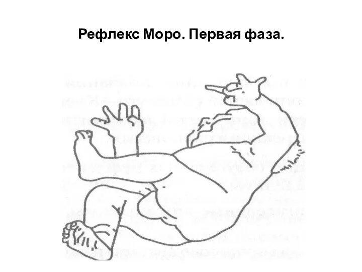 Рефлекс Моро. Первая фаза.