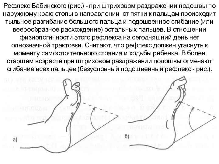 Рефлекс Бабинского (рис.) - при штриховом раздражении подошвы по наружному краю стопы