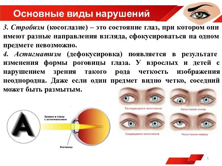 Основные виды нарушений 3. Стробизм (косоглазие) – это состояние глаз, при котором