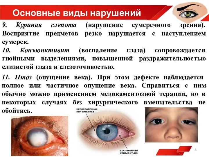 Основные виды нарушений 9. Куриная слепота (нарушение сумеречного зрения). Восприятие предметов резко