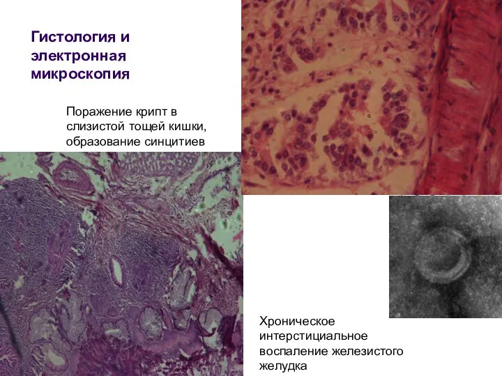 Гистология и электронная микроскопия Поражение крипт в слизистой тощей кишки, образование синцитиев