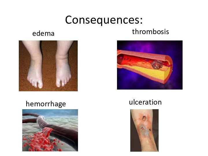 Consequences: edema thrombosis hemorrhage ulceration