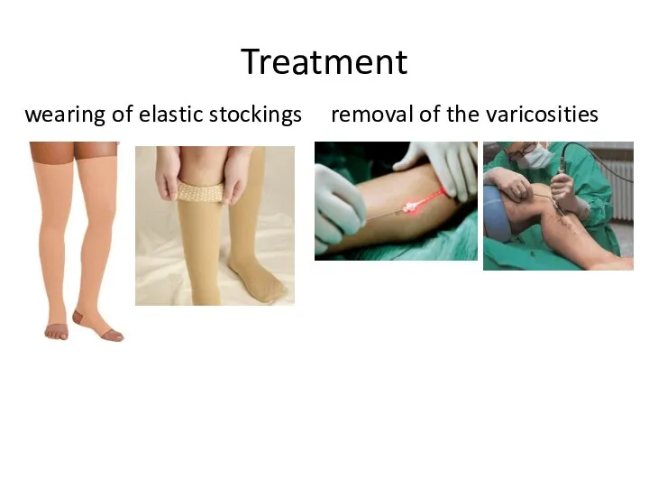 Treatment wearing of elastic stockings removal of the varicosities
