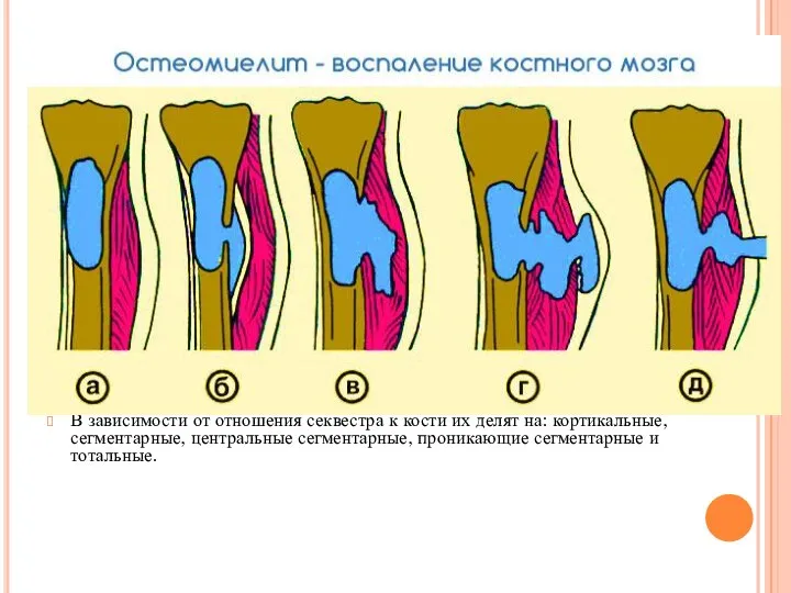 Воспаление костного мозга сустава. Острый и хронический гематогенный остеомиелит. Остеомиелит Гарре большеберцовой кости.