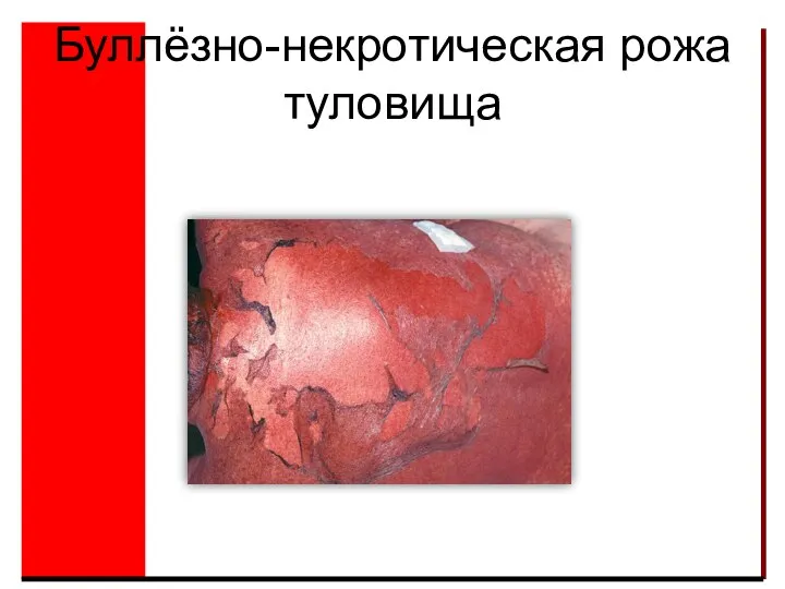 Буллёзно-некротическая рожа туловища