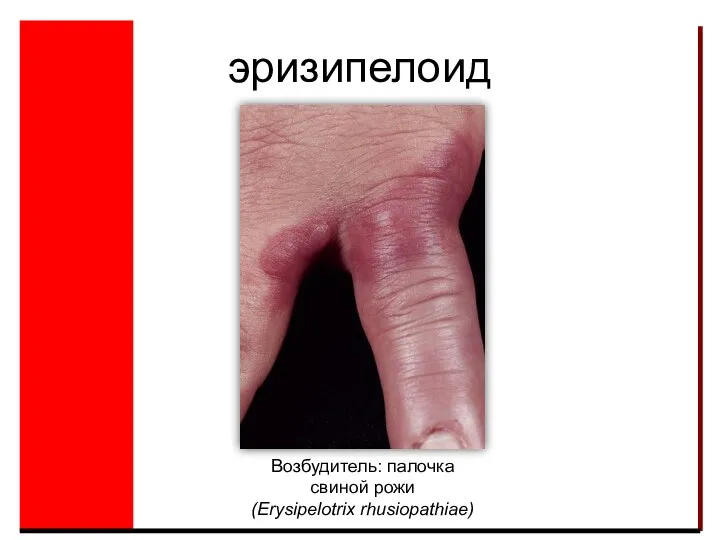 эризипелоид Возбудитель: палочка свиной рожи (Erysipelotrix rhusiopathiae)