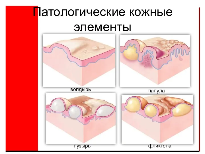 Патологические кожные элементы папула волдырь пузырь фликтена