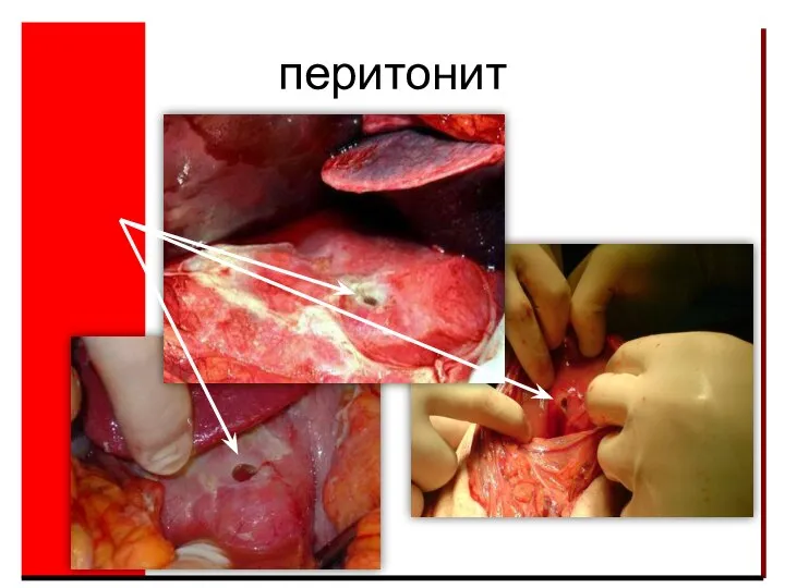 перитонит