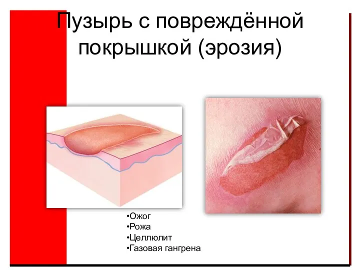 Пузырь с повреждённой покрышкой (эрозия) Ожог Рожа Целлюлит Газовая гангрена