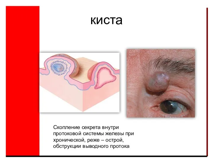 киста Скопление секрета внутри протоковой системы железы при хронической, реже – острой, обструкции выводного протока