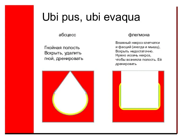 Ubi pus, ubi evaqua абсцесс флегмона Гнойная полость Вскрыть, удалить гной, дренировать