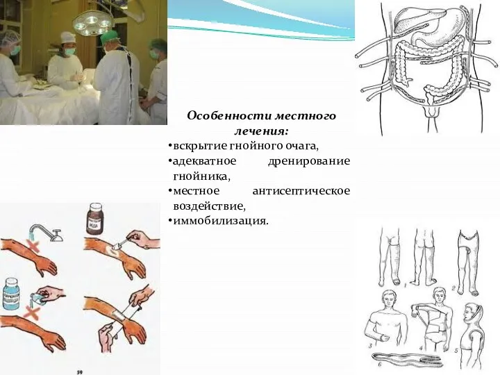 Особенности местного лечения: вскрытие гнойного очага, адекватное дренирование гнойника, местное антисептическое воздействие, иммобилизация.