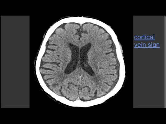 cortical vein sign