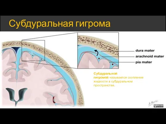 Субдуральная гигрома Субдуральной гигромой называется скопление жидкости в субдуральном пространстве.
