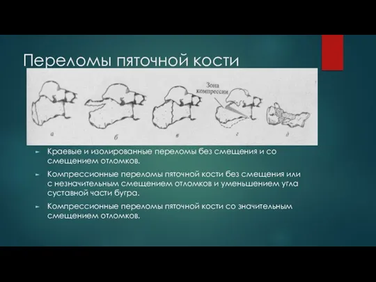 Переломы пяточной кости Краевые и изолированные переломы без смещения и со смещением