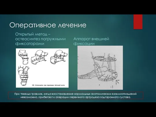 Оперативное лечение Открытый метод – остеосинтез погружными фиксаторами Аппарат внешней фиксации При